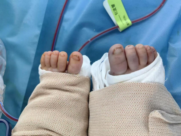 泰安配资 女婴小腿完全离断，“保腿”之战创年龄最小纪录